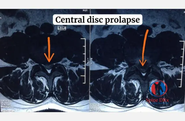 “Recovering from Disc Prolapse: 36-Year-Old Triumphs Over Sudden Foot Drop and Emerges Stronger”