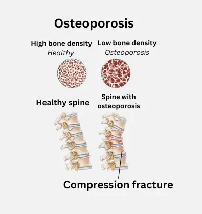 Osteoporotic Fractures Treatment Bangalore