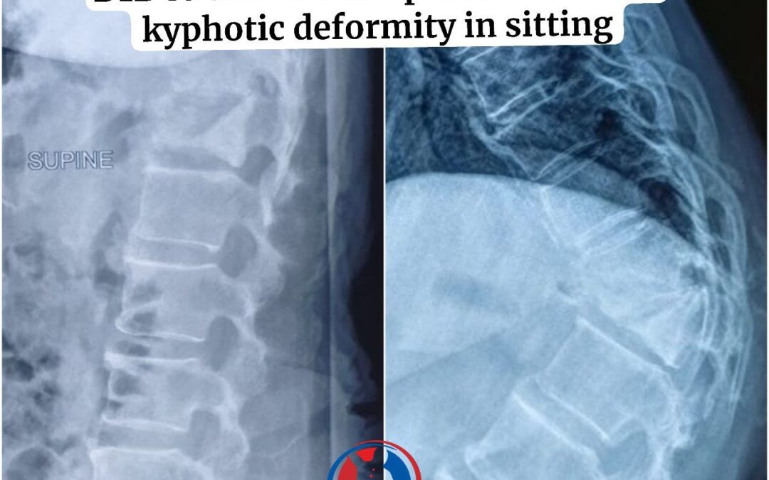 Neglected Osteoporotic Vertebral fracture