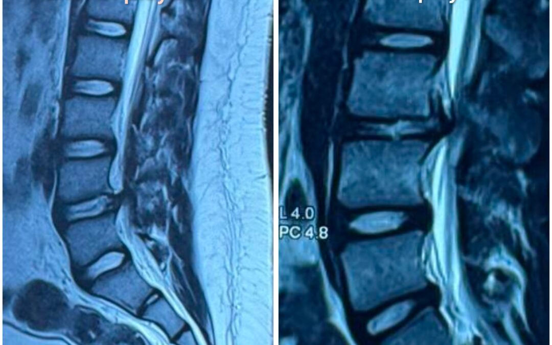Teenage Disc Prolapse – A Hidden Threat in Young Athletes