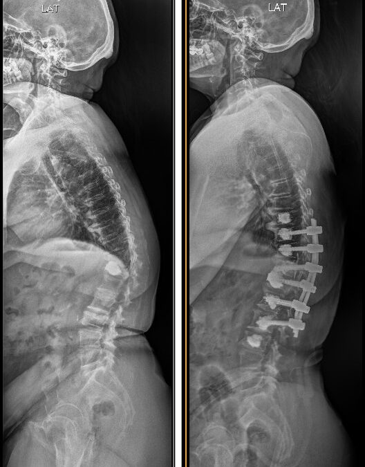 Osteoporotic Spine Fracture in a 65-Year-Old – A Case of Recovery Through Holistic Spine Care