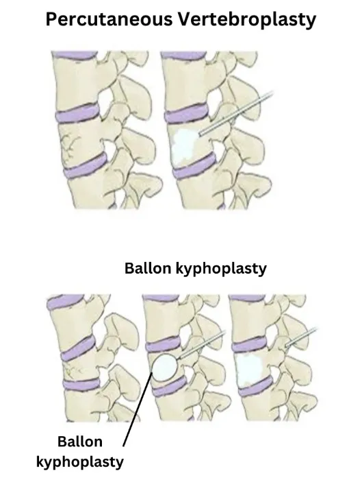 Kyphoplasty-Surgery