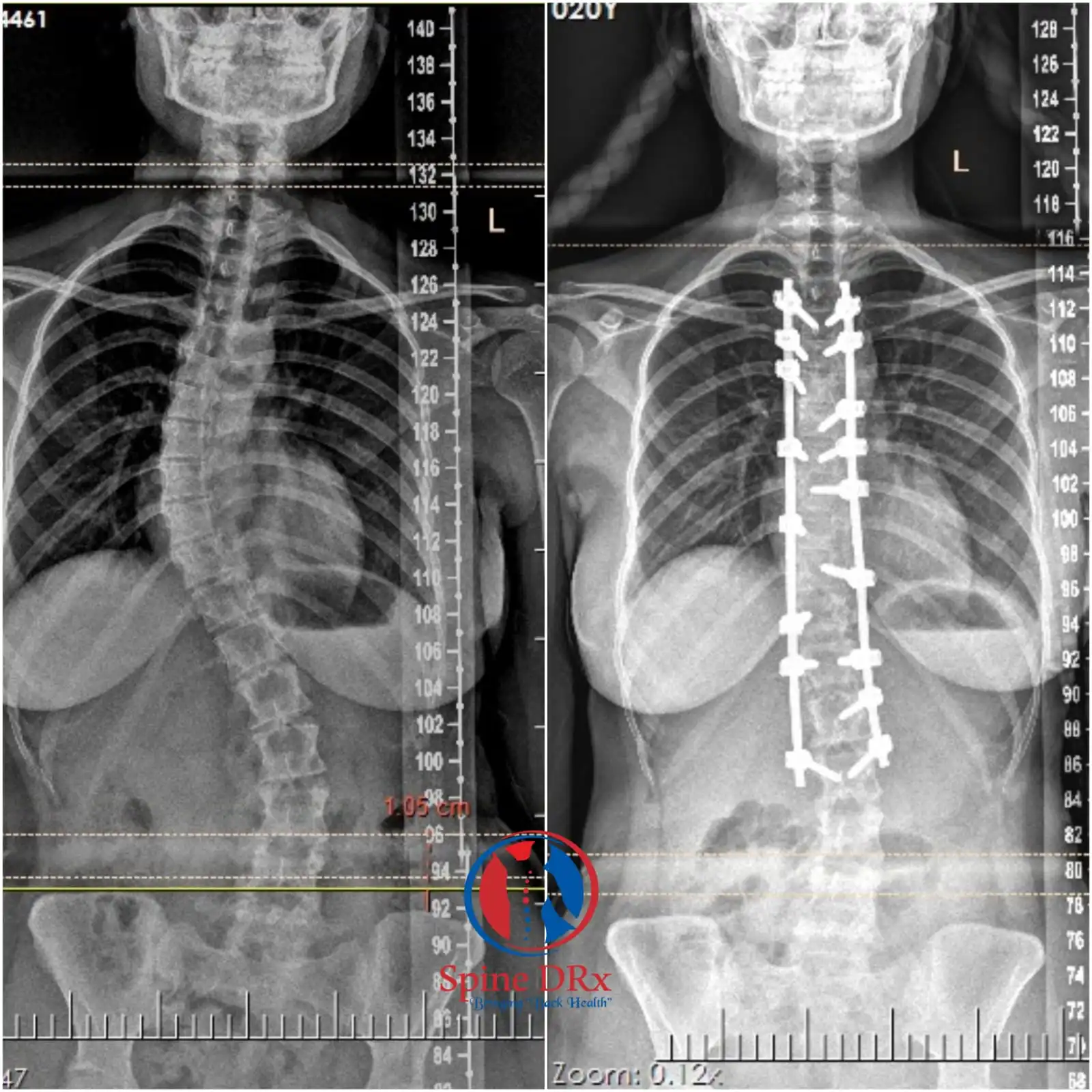 Spinal Osteotomy Surgery