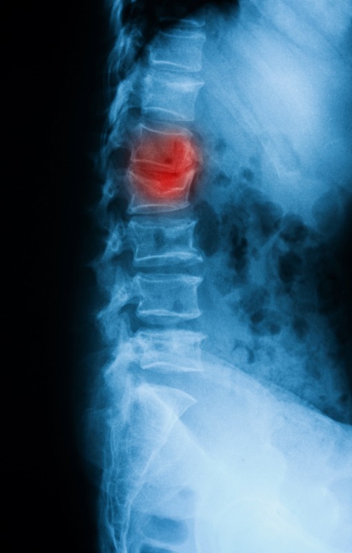 Vertebral Compression Fracture